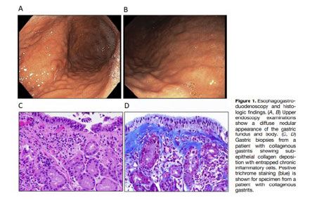 endoscopia gastritis colagena